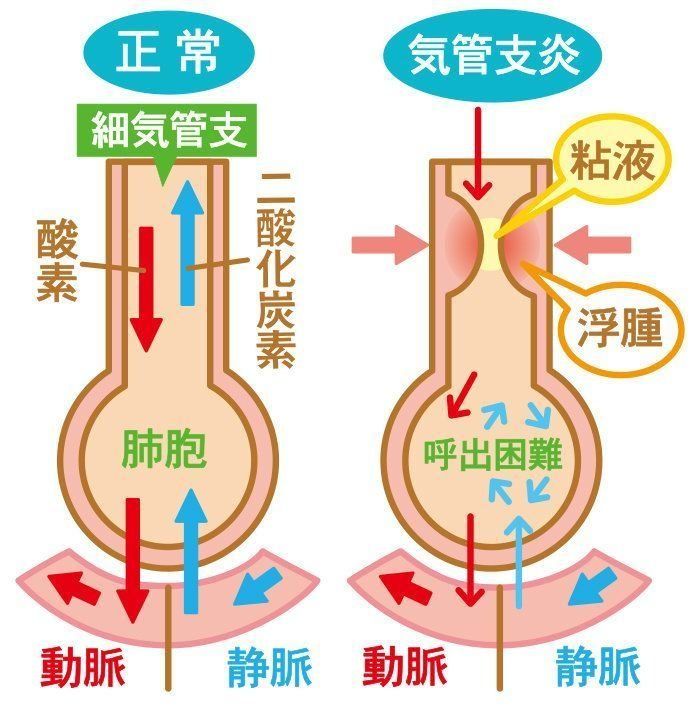 赤ちゃん のど 気管支 肺の病気 気管支炎の症状とケア 医師監修 たまひよ