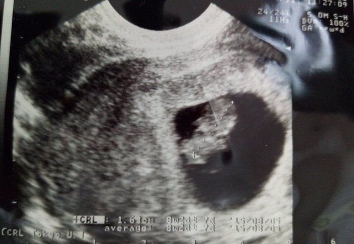 妊娠8週 赤ちゃんのエコー写真 超音波写真まとめ たまひよ