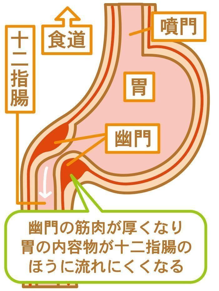 赤ちゃんのおなかの病気 肥厚性幽門狭窄症の症状とケア 医師監修 たまひよ