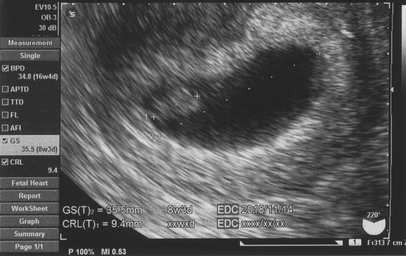 2度の流産経験後 念願の第一子妊娠をエコーで振り返る たまひよ 2度の流産経験後 念願の第一子妊娠をエコーで振り返る たまひよ