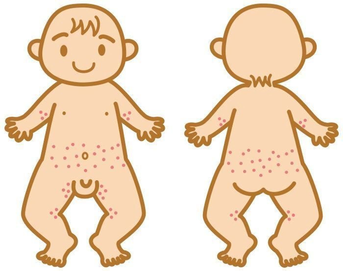 赤ちゃんの皮膚の病気 水いぼ 伝染性軟属腫の症状とケア 医師監修 たまひよ 赤ちゃんの皮膚の病気 水いぼ 伝染性軟属腫の症状とケア 医師監修 たまひよ