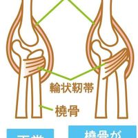 コロナ禍は子どもの骨にも影響が 骨の成長を阻害する3つの問題点 小児整形外科医 たまひよ コロナ禍は子どもの骨にも影響が 骨の成長を阻害する3つの問題点 小児整形外科医 たまひよ