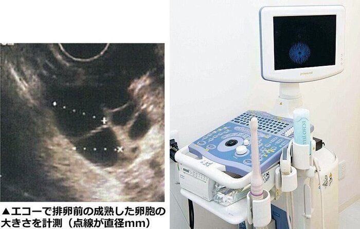 エコーで排卵前の成熟した卵胞の大きさを計測（点線が直径mm）