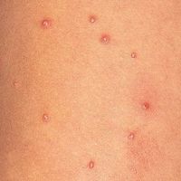 医師監修 夏の赤ちゃん皮膚トラブル とびひ 虫刺され 水いぼ 悪化させないケア方法は たまひよ 医師監修 夏の赤ちゃん皮膚トラブル とびひ 虫刺され 水いぼ 悪化させないケア方法は たまひよ