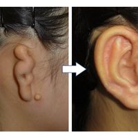 小さい耳で生まれたわが子 妊婦健診では分からなかった 耳が小さい 聞こえない とネット検索を繰り返した日々 体験談 たまひよ 小さい耳で生まれたわが子 妊婦健診では分からなかった 耳が小さい 聞こえない とネット検索を繰り返した日々 体験談 たまひよ