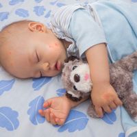 医師監修 赤ちゃんが虫に刺されて 分後にアレルギー症状 蚊 ダニ ハチ Etc 子どもが刺されたときの応急処置 予防対策 たまひよ 医師監修 赤ちゃんが虫に刺されて 分後にアレルギー症状 蚊 ダニ ハチ Etc 子どもが刺されたときの応急処置 予防対策 たまひよ