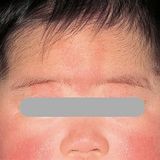 医師監修 赤ちゃんの あざ はなぜできる ほうっておいて大丈夫 ９症状を小児科医が解説 たまひよ