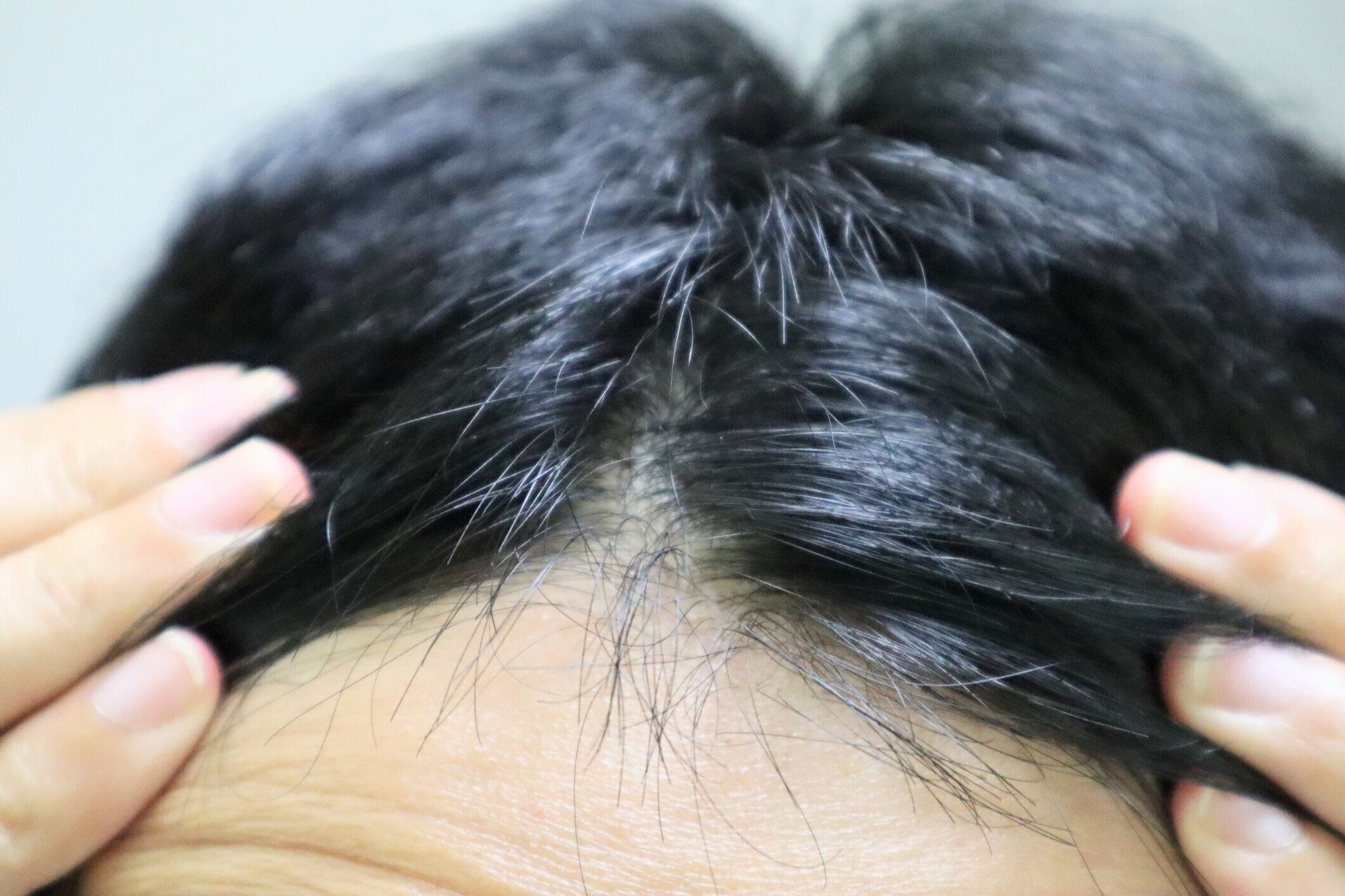 頭皮トラブルのイメージ